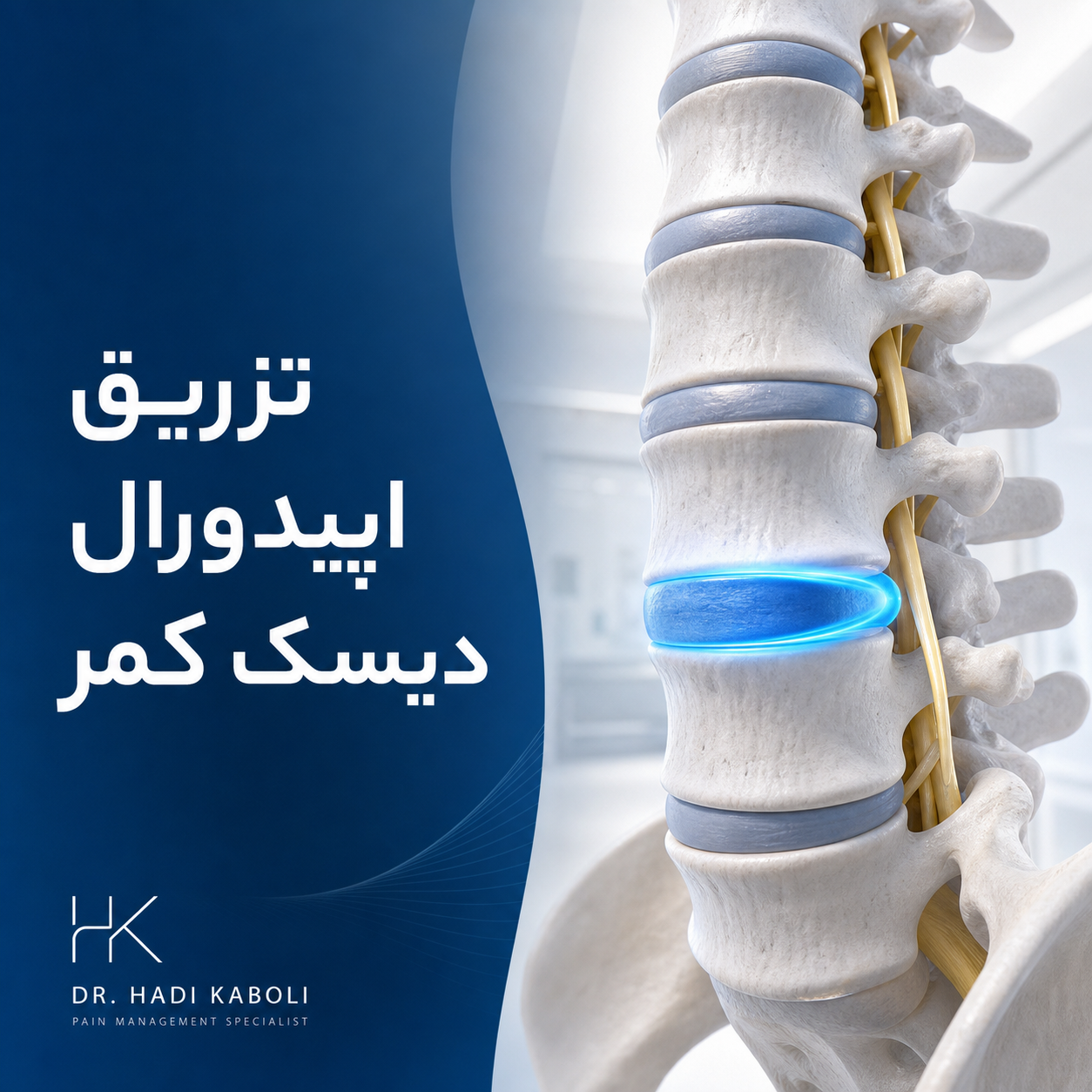 تزریق اپیدورال دیسک کمر