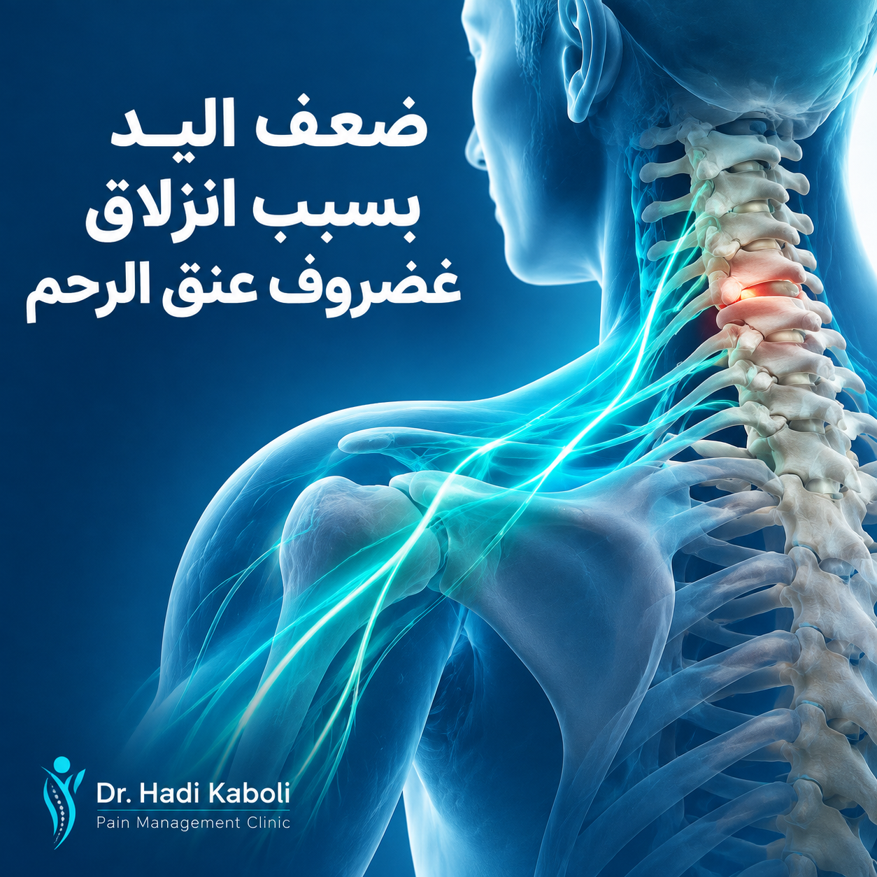 ضعف اليد بسبب انزلاق غضروف عنق الرحم